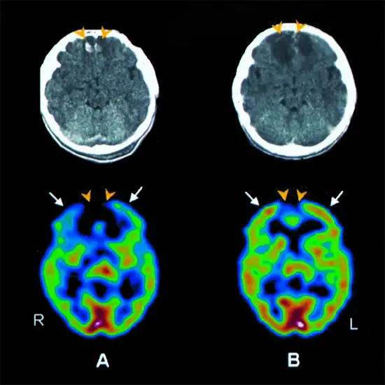 spect cerebral perfusion scan